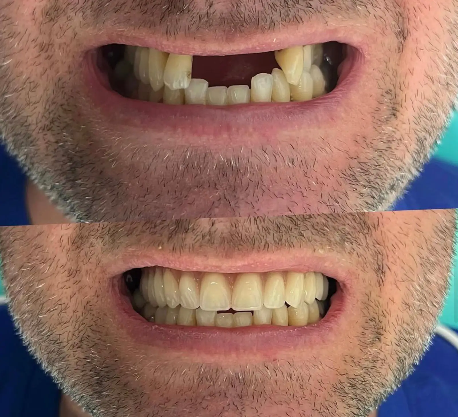 Antes e Depois - 5 (1)