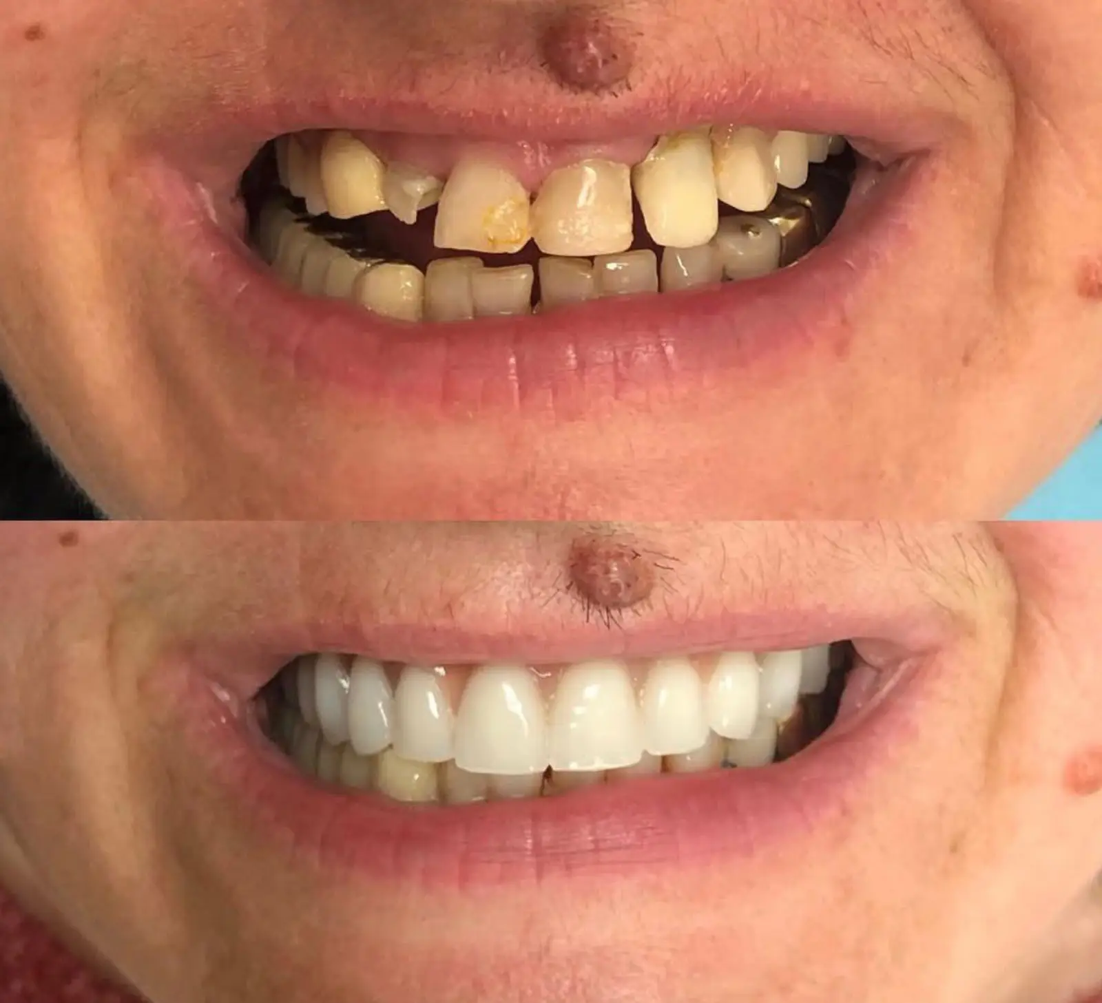 Antes e Depois - 5 (3)