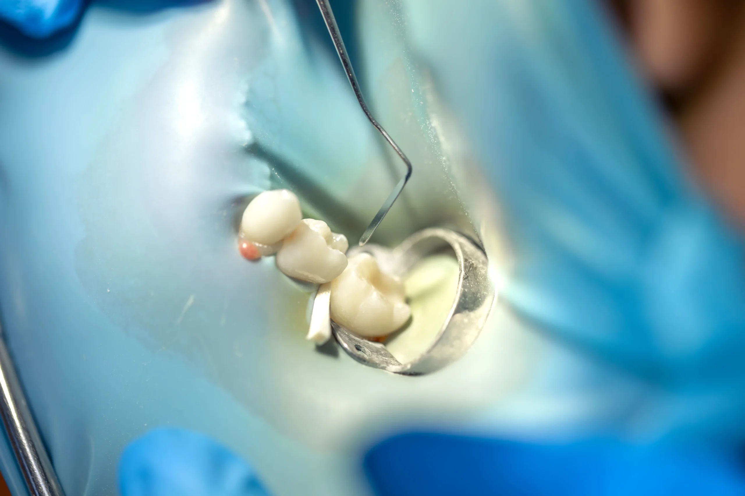 young-man-with-toothy-smile-demonstrating-his-dental-implant (5) (1)